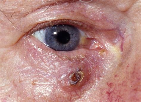 Basal cell carcinoma/rodent ulcer