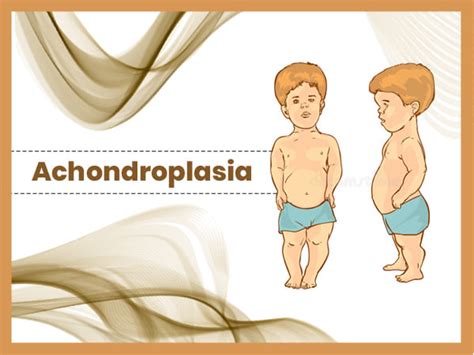 Achondroplasia: Causes, Symptoms, Diagnosis And Treatment - Boldsky.com