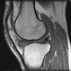 4 Meniscal Cyst | Radiology Key