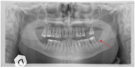 Jaw Cancer Xray - CancerWalls