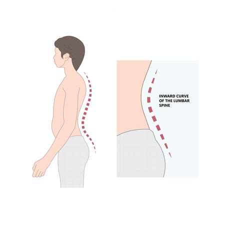 Hyperlordosis- Should It Worry You? We Give You 4 Exercises