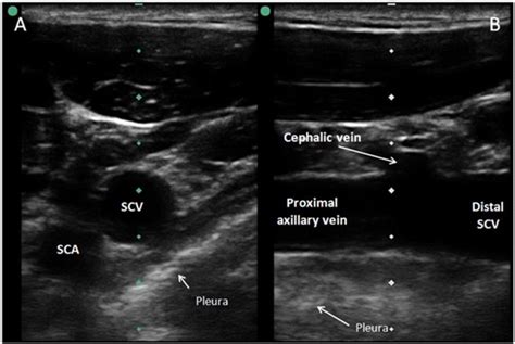 Comparison Of Ultrasound-guided Internal Jugular Vein And, 52% OFF