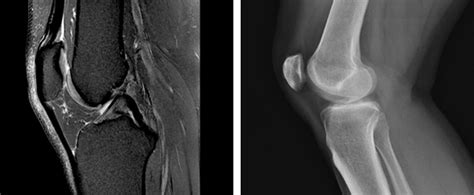 Why Do I Need a Knee MRI? | Wake Radiology