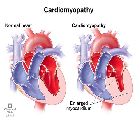 Understanding Cardiomyopathy: Causes, Types, Symptoms, and Treatments