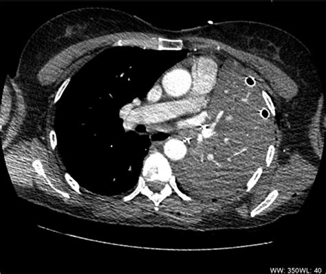 CT scan shows acute angulation of left lung hilum with complete ...