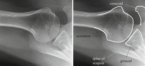 Shoulder Radiology | Musculoskeletal Key