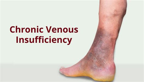 chronic venous insufficiency treatment guidelines | Dr Abhilash