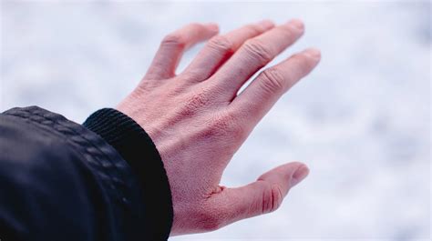 7 frostbite symptoms you should never ignore - Success Centre