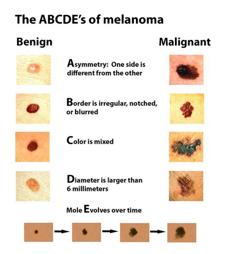 Melanoma - Harvard Health