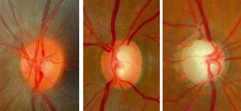 Community Eye Health Journal » The optic nerve head in glaucoma