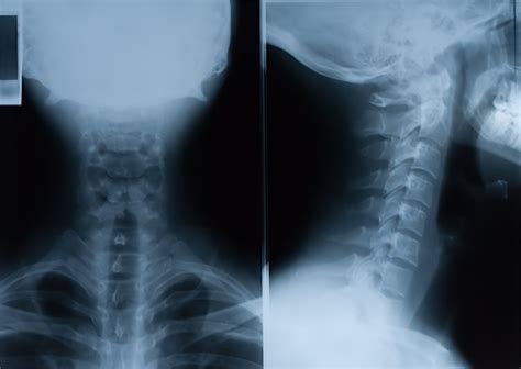 Gene Mutations and Neoantigens in Head and Neck Tumors | Oncotarget