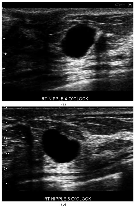 Cancers | Free Full-Text | Retroareolar Carcinomas in Breast Ultrasound ...