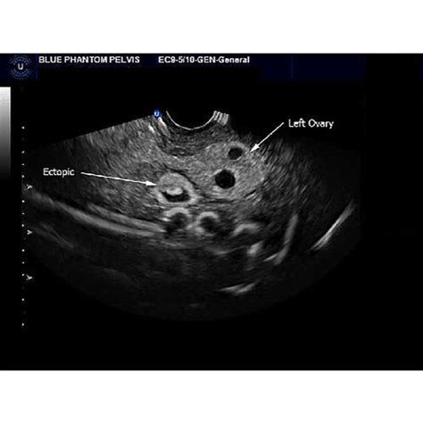 Blue Phantom Ectopic Pregnancy Transvaginal Ultrasound Training Model ...