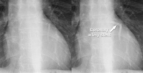 Chest X-ray - Cardiac disease - Other artifacts