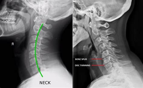 Pinched Nerve in the Neck | Align Corrective Chiropractic