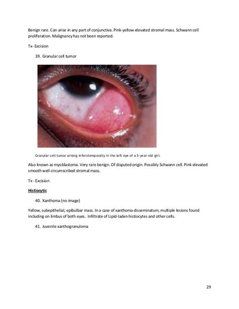 Conjunctival tumors