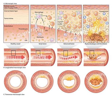 Atherosclerosis - Cardiovascular - Medbullets Step 1