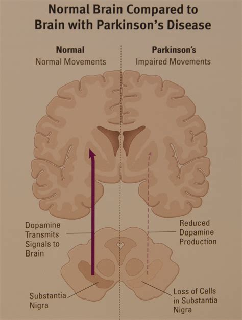 Valley Neurology | Understanding Parkinson's Disease