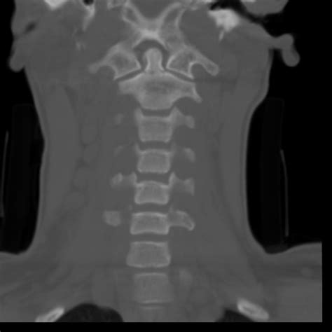 C-Spine Injuries + CT Interpretation – Core EM