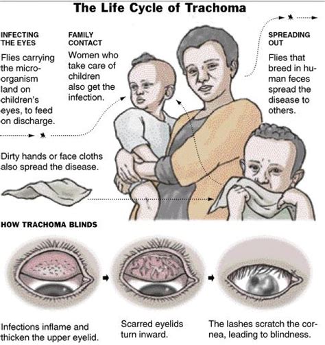 Trachoma – Definition, Symptoms, Treatment, Pictures, Causes