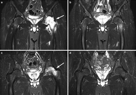 Bone Marrow Edema Pattern | Radiology Key