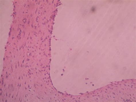 MENISCAL CYST – Histopathology.guru