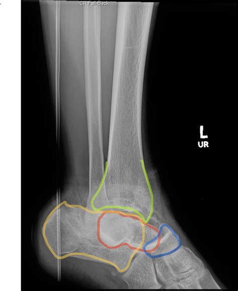 Subtalar Dislocation. XRay Lateral Annotated. JETem 2019 - JETem