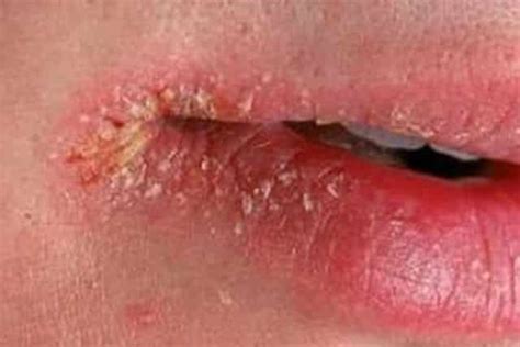 Dry Patches on Lip, Upper, Lower, Pictures, Causes, Not Cold Sore ...