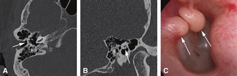 External auditory canal exostoses. Two small bony protuberances were ...