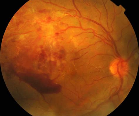 Retinal vasculitis causes, symptoms, diagnosis, treatment & prognosis