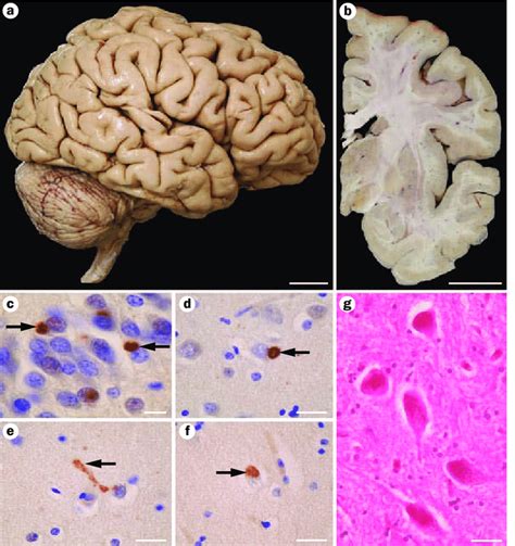 | Neuropathology of the patient's brain. a | Mild atrophy of the ...