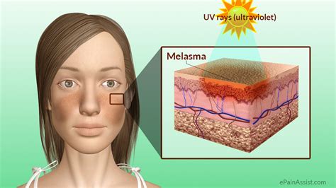 Up to date Medicine: MELASMA DIAGNOSIS AND TREATMENT