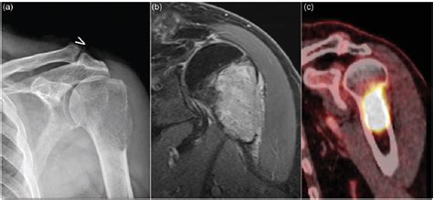 Figure 1 from Diagnosis of bone metastasis from thyroid carcinoma: a ...