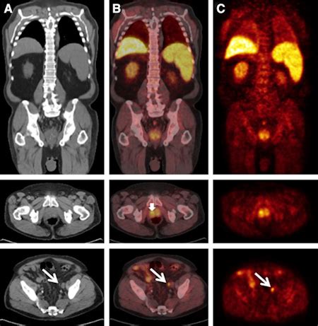 C-11 acetate PET/CT helps patients before prostatectomy