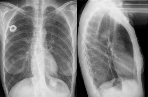 Oesophageal Cancer - Clinical Features - Investigations - TeachMeSurgery