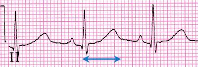 Study Medical Photos: QT Interval Prolongation On ECG