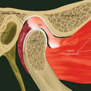 TMJ anterior disc displacement without reduction (ADDwoR). | Download ...