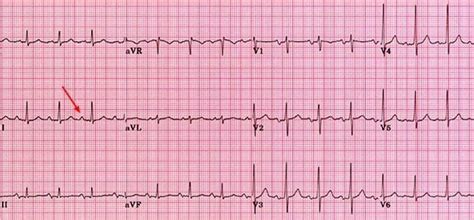 Left atrial enlargement