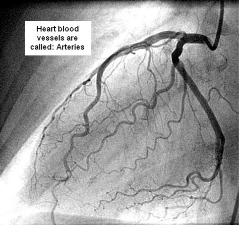 Coronary Angiography Anatomy - Anatomy Book