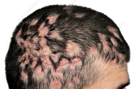 Dissecting folliculitis on the scalp - Stock Image - C011/9521 ...