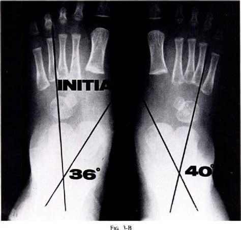 Talipes Calcaneovalgus | Semantic Scholar