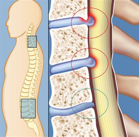 Minimally Invasive Microdecompression | Manhattan Spine Consultants