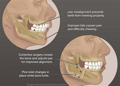 Jaw Surgery