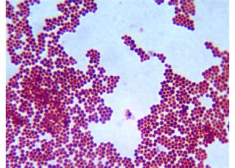 Gram staining of Staph aureus showing typical gram positive cocci ...