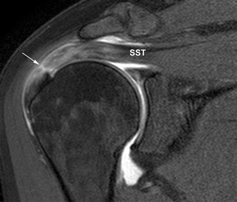 Rotator Cuff Mri Images