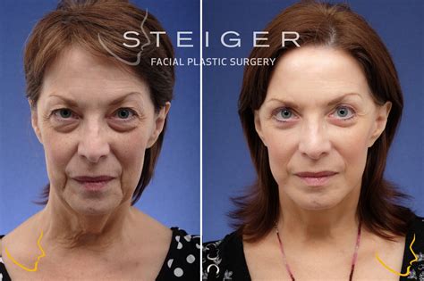 Facelift Before and After Photos | Deep Plane Facelift