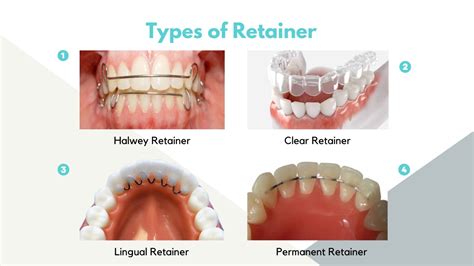 √ Retainer Price and Types in Philippines 2024