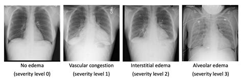 Quantification of Pulmonary Edema in Chest Radiographs | MIT CSAIL