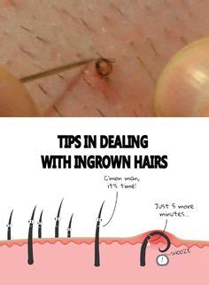 9 Best Ingrown Hair ideas | ingrown hair, ingrown hair removal, simple ...