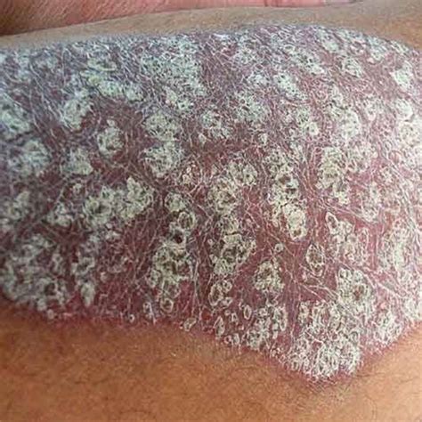 Psoriasis - Skin condition explained and several effective treatments ...